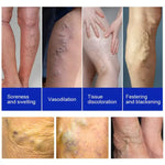 💜 VarixRelief™ Parches Naturales Anti-Varices