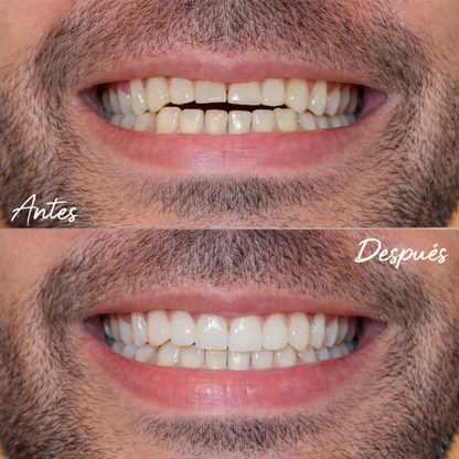 PerfectSmile™ – Carillas Dentales a Presión para una Sonrisa Inmediata