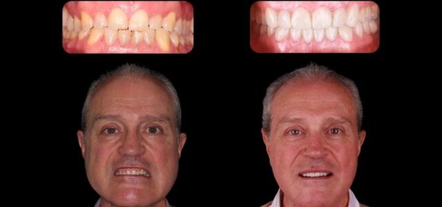 PerfectSmile™ – Carillas Dentales a Presión para una Sonrisa Inmediata