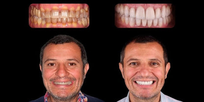 PerfectSmile™ – Carillas Dentales a Presión para una Sonrisa Inmediata