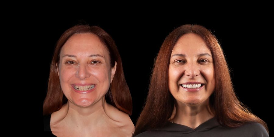 PerfectSmile™ – Carillas Dentales a Presión para una Sonrisa Inmediata